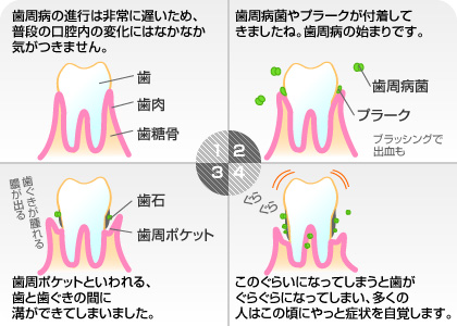 歯周病の進行段階